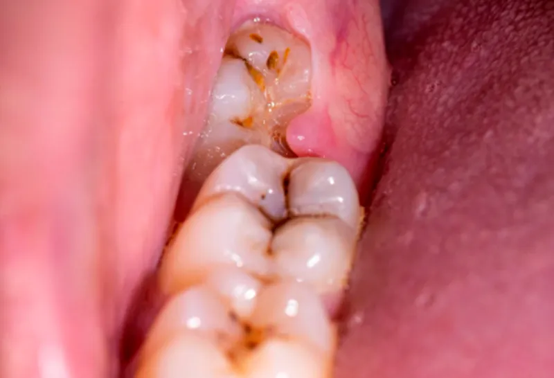Cirurgia Oral Menor